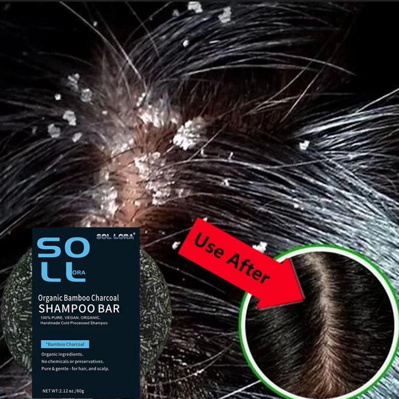 Hair Care Dandruff - Fast Anti Dandruff Hair Treatment สบู่อาการคันซ่อมทําความสะอาดหนังศีรษะ