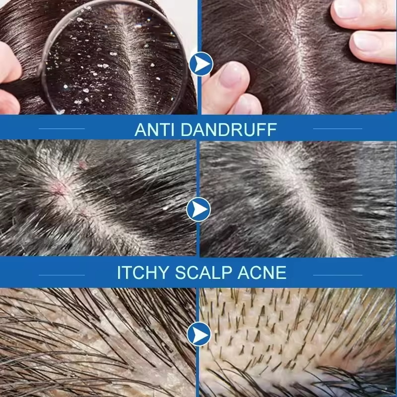 Fast Anti Dandruff Hair Treatm - Hair Care Dandruff บทวิจารณ์และราคา
