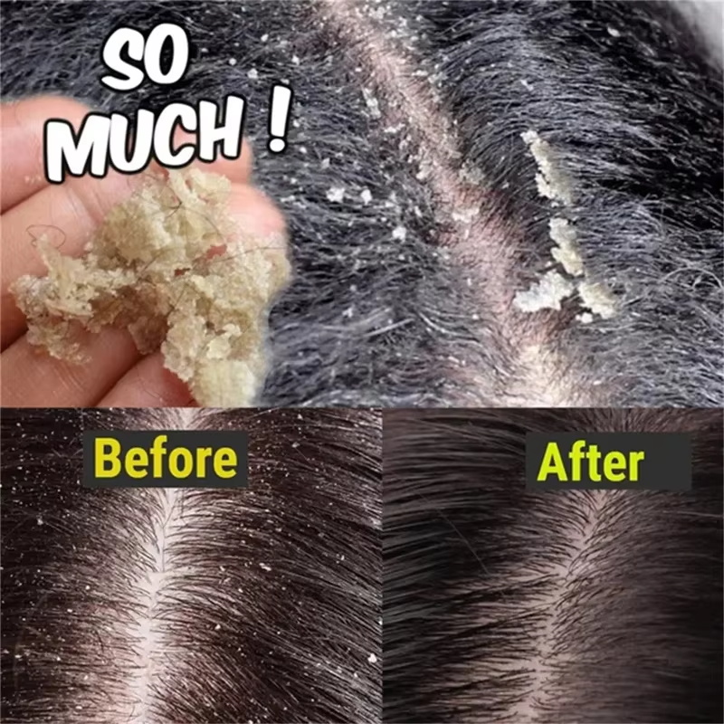 Fast Anti Dandruff Hair Treatm - Hair Care Dandruff บทวิจารณ์และราคา